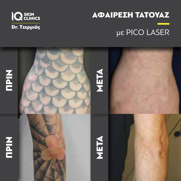 Tattoo_Removal_Results2
