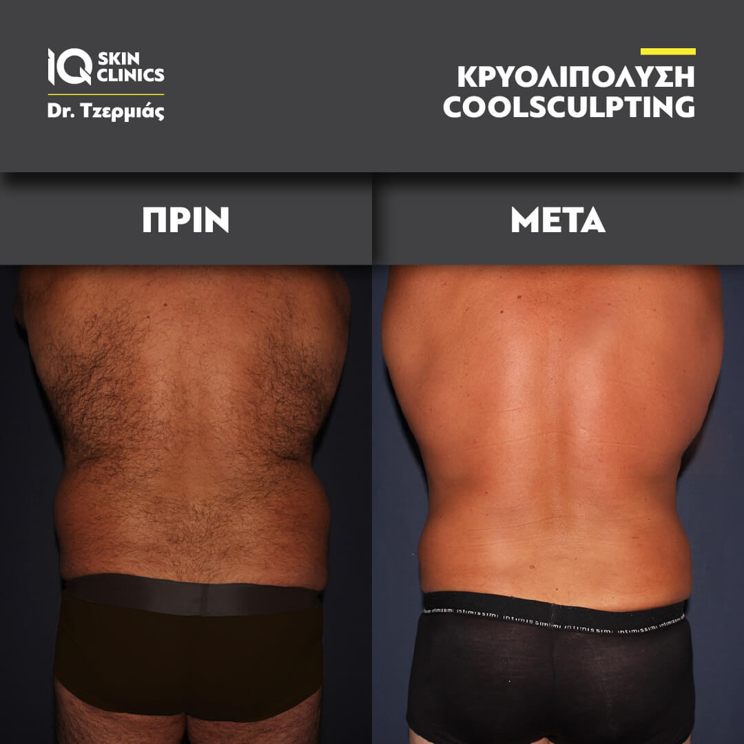 Coolsculpting before after