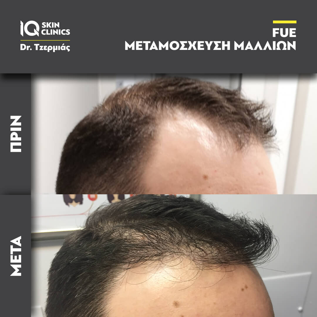 Μεταμόσχευση μαλλιών - Πριν & Μετά