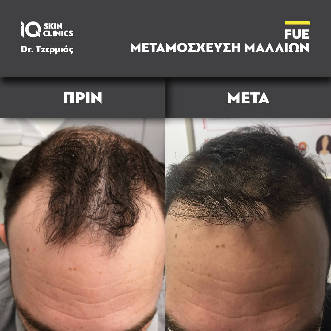 Μεταμόσχευση μαλλιών - Πριν & Μετά