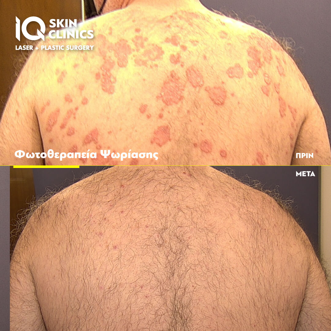 psoriasi_before_after