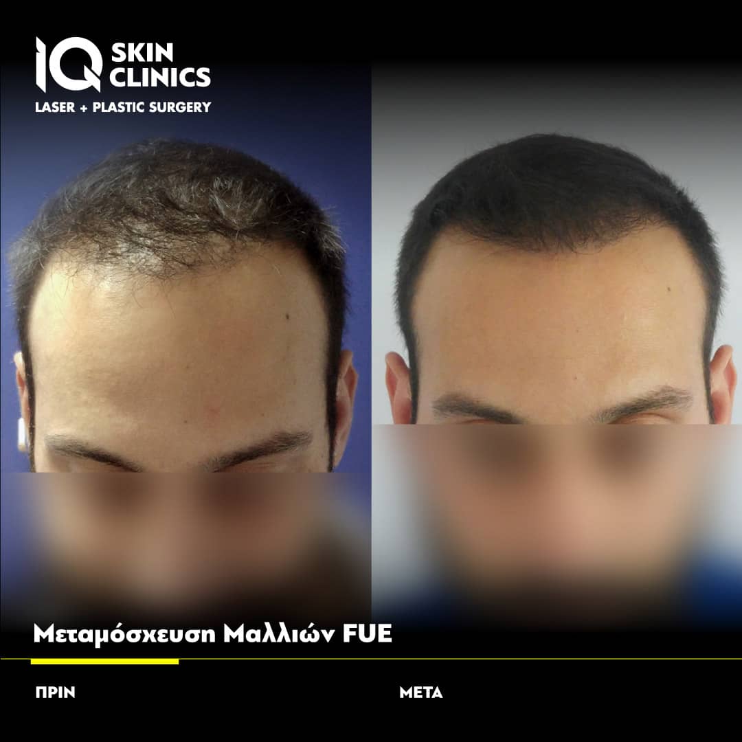 Δείτε αποτελέσματα μεταμόσχευσης μαλλιών IQ FUE με εγγύηση από τον Dr. Τζερμιά