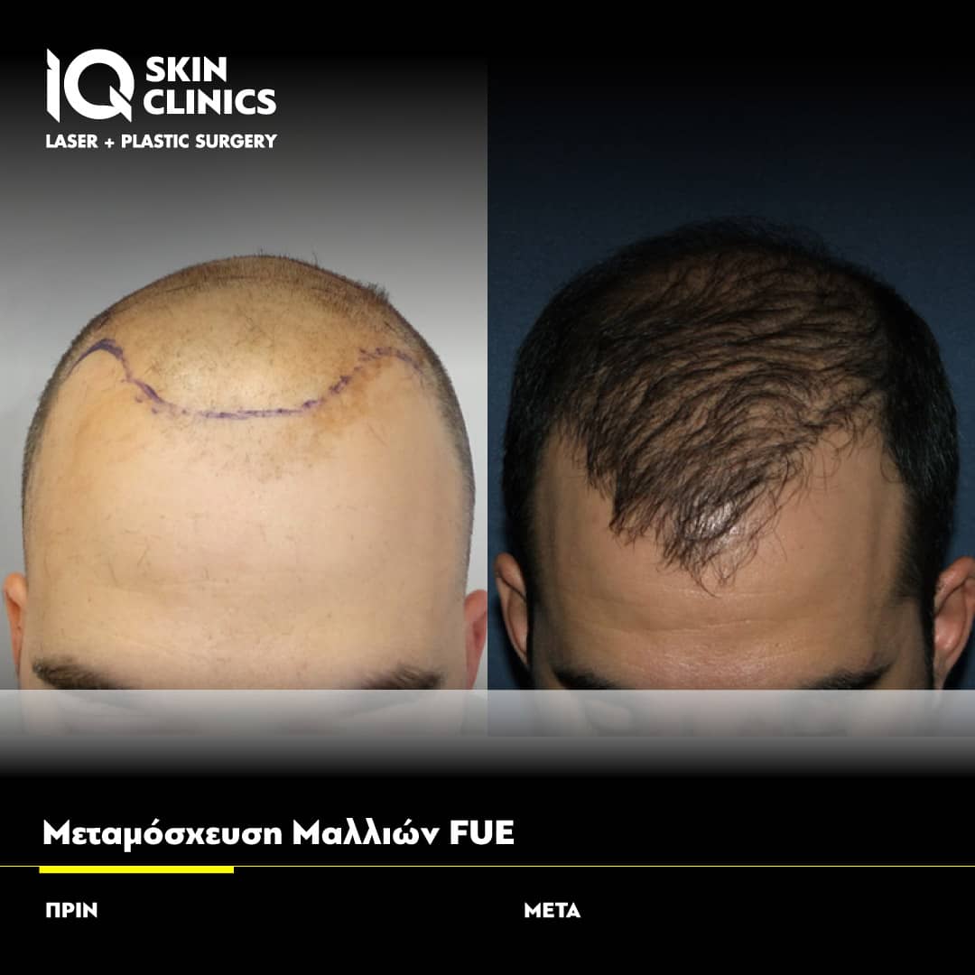 Δείτε αποτελέσματα μεταμόσχευσης μαλλιών IQ FUE με εγγύηση από τον Dr. Τζερμιά