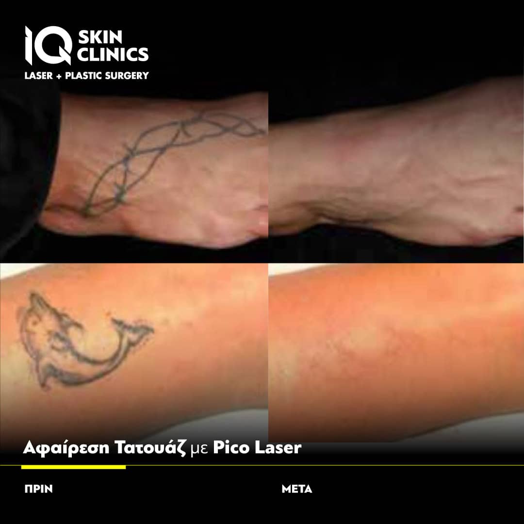 Δείτε αποτελέσματα αφαίρεσης τατουάζ όλων των χρωμάτων με IQ PICO LASER