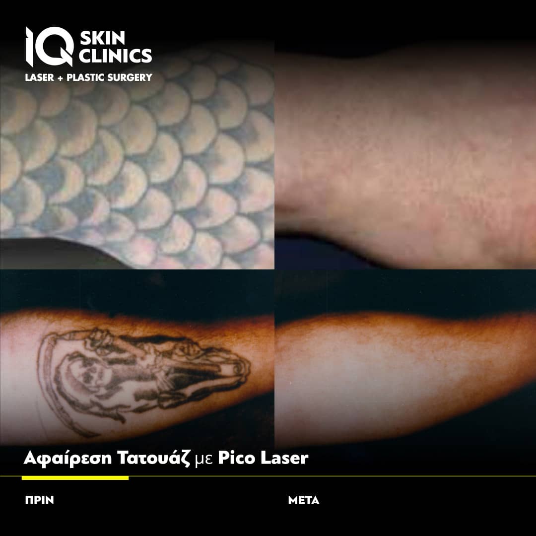 Δείτε αποτελέσματα αφαίρεσης τατουάζ όλων των χρωμάτων με IQ PICO LASER