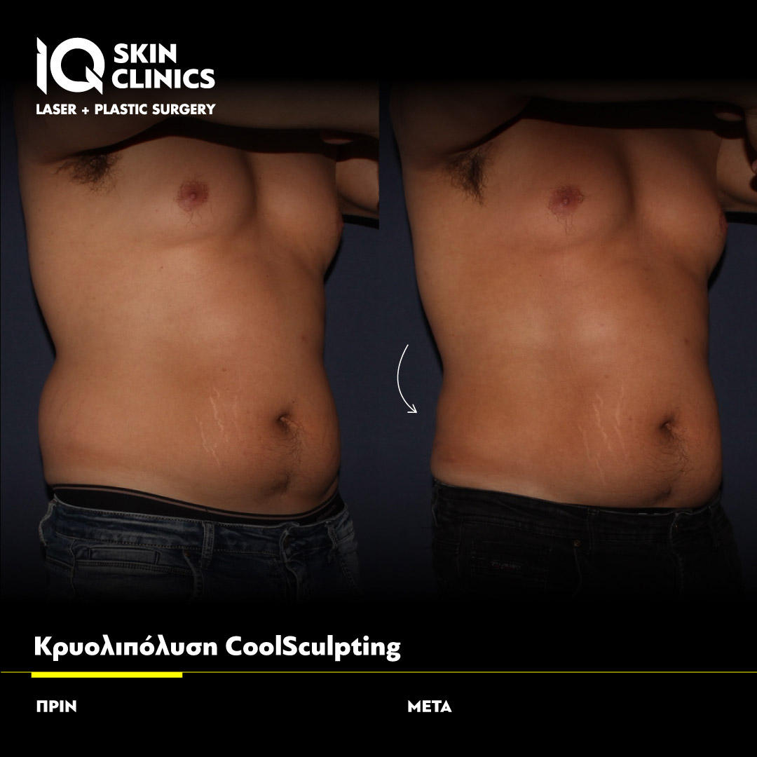 Coolsculpting_Template_010_Site