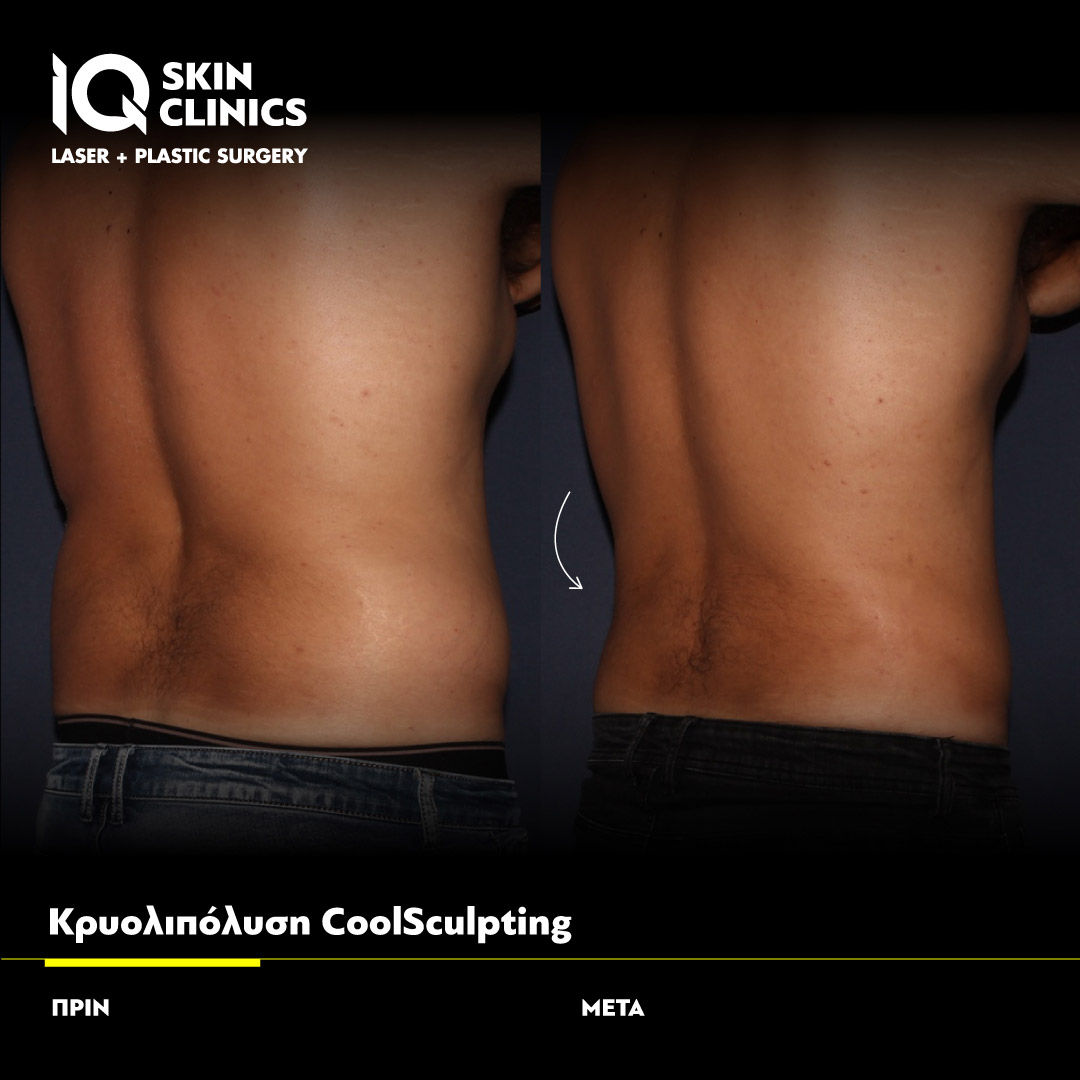 Coolsculpting_Template_011_Site
