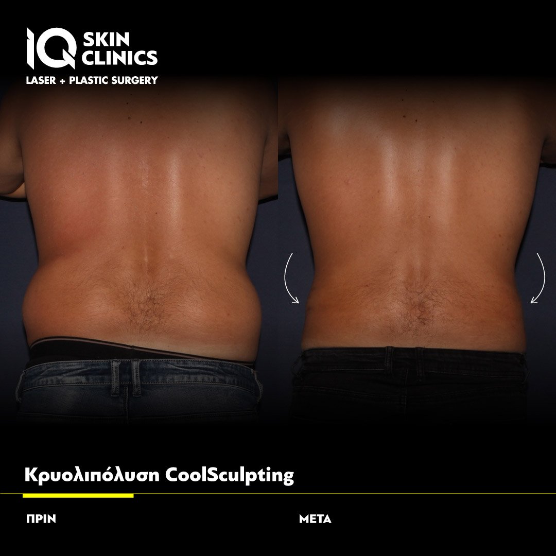 Coolsculpting_Template_012_Site