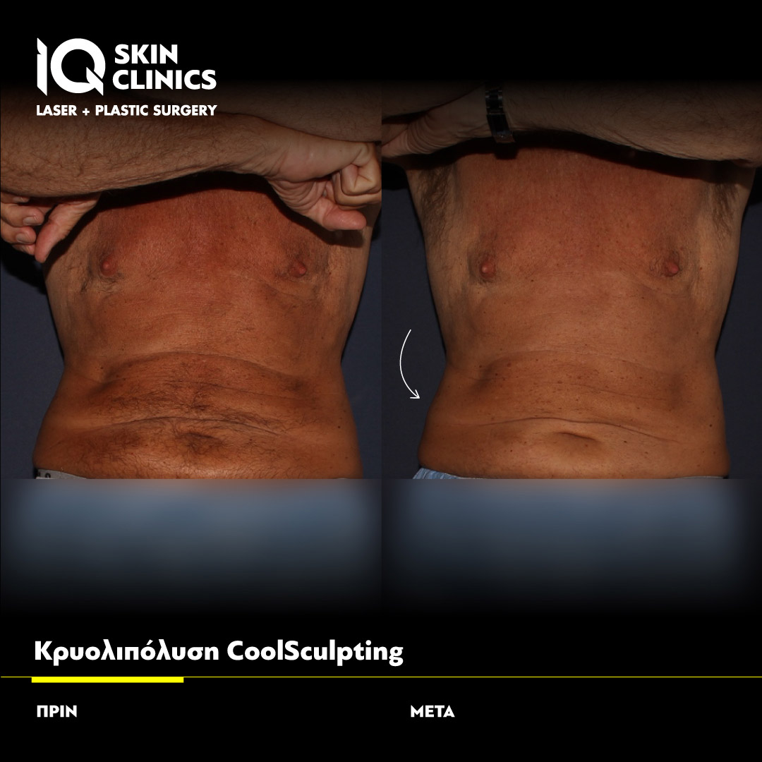 Coolsculpting_Template_013_Site