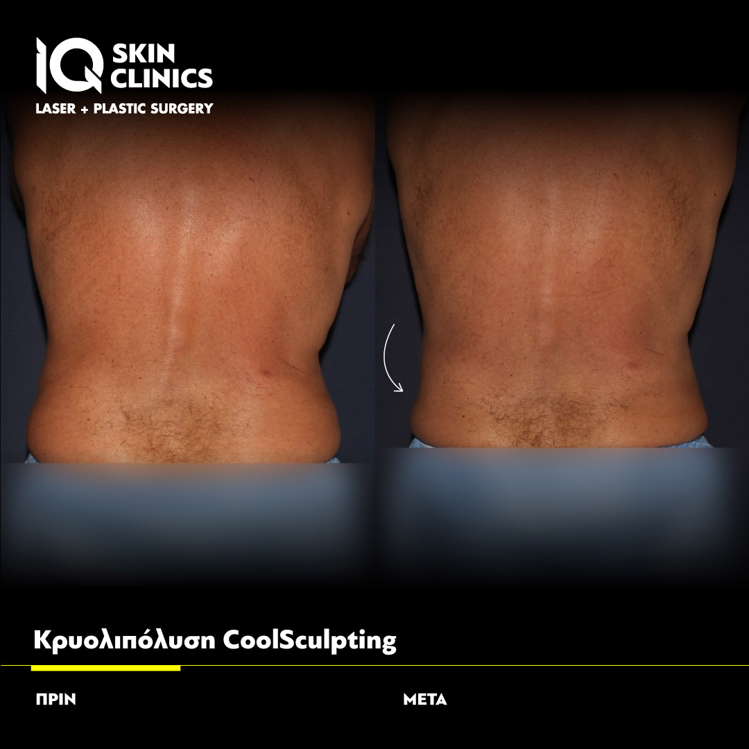 Coolsculpting_Template_014_Site