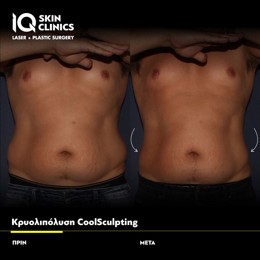 Coolsculpting_Template_08_Site
