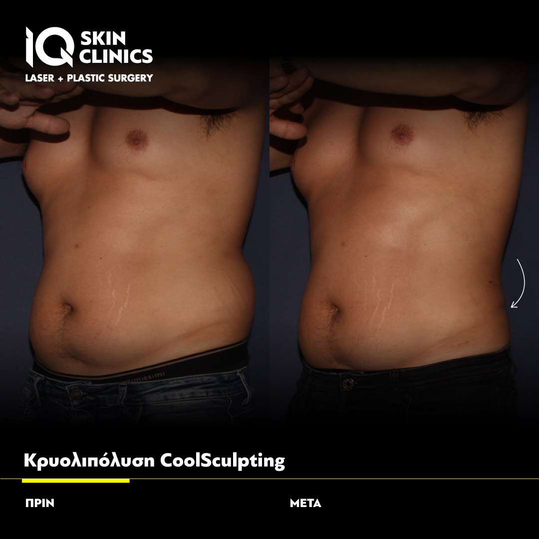 Coolsculpting_Template_09_Site
