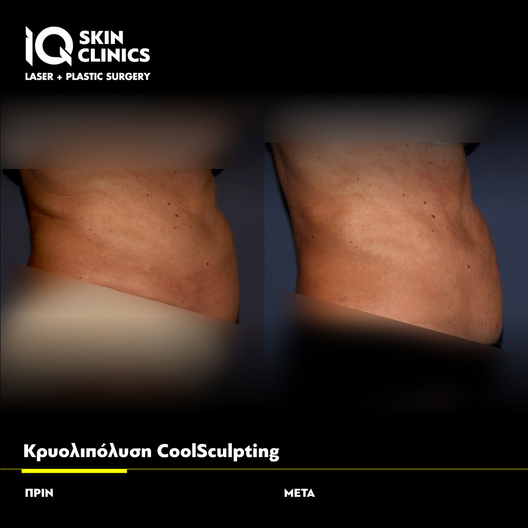 Coolsculpting_Template_015_Site (1)