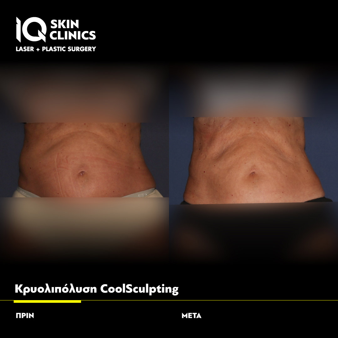 Coolsculpting_Template_016_Site (1)