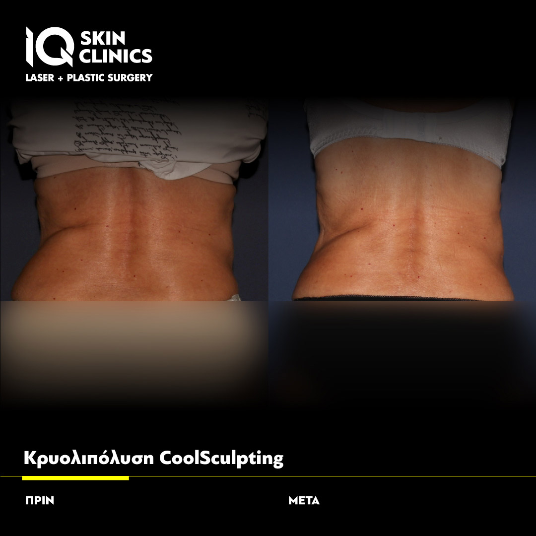 Coolsculpting_Template_017_Site (1)