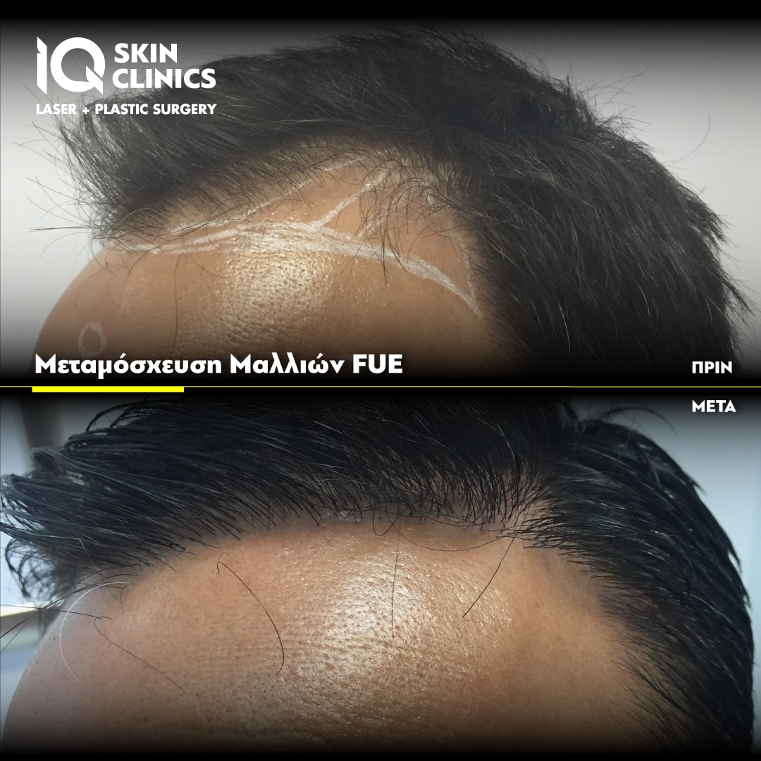 IQ SKIN CLINICS Πριν Μετά FUE Μεταμόσχευση Μαλλιών
