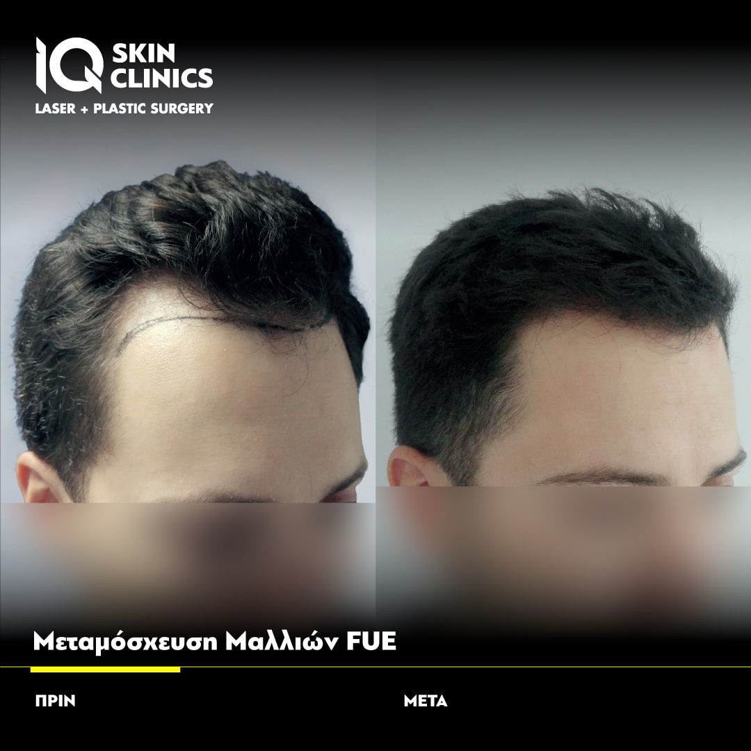 IQ SKIN CLINICS Πριν Μετά FUE Μεταμόσχευση Μαλλιών