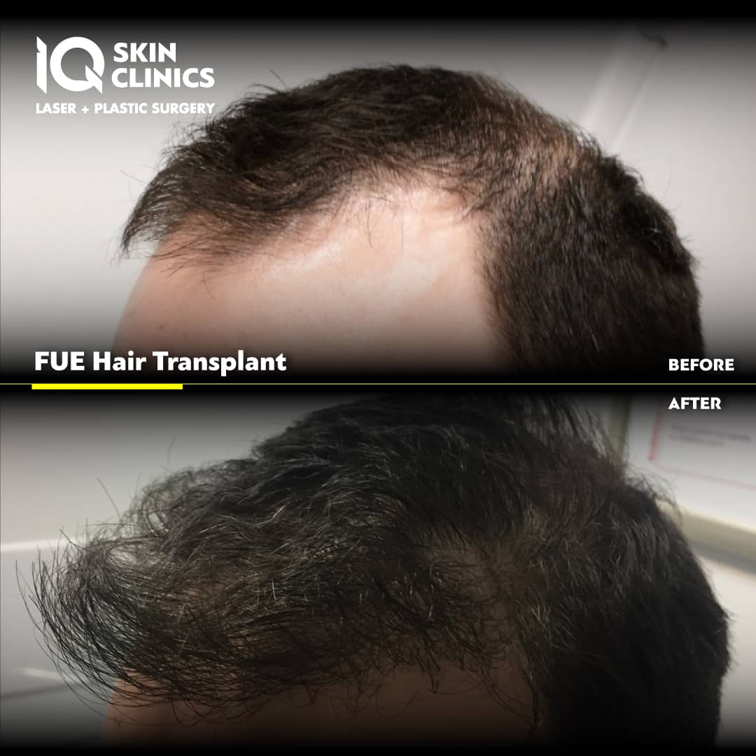 IQ SKIN CLINICS Before After FUE Hair Transplant