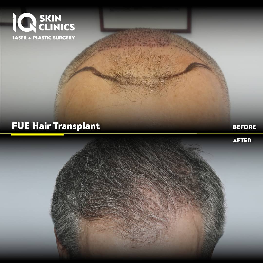IQ SKIN CLINICS Before After FUE Hair Transplant